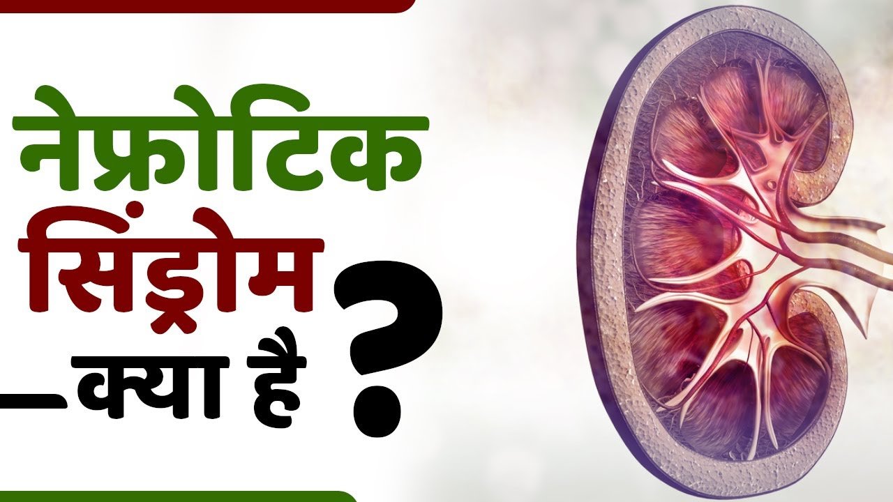 किडनी रोग का संकेत हो सकता है नेफ्रोटिक सिंड्रोम, समय रहते पहचानें ये अहम संकेत